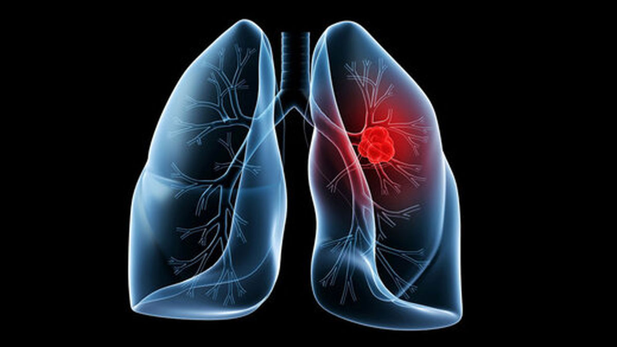کشف روشی برای درمان یکی از مرگبارترین انواع سرطان ریه